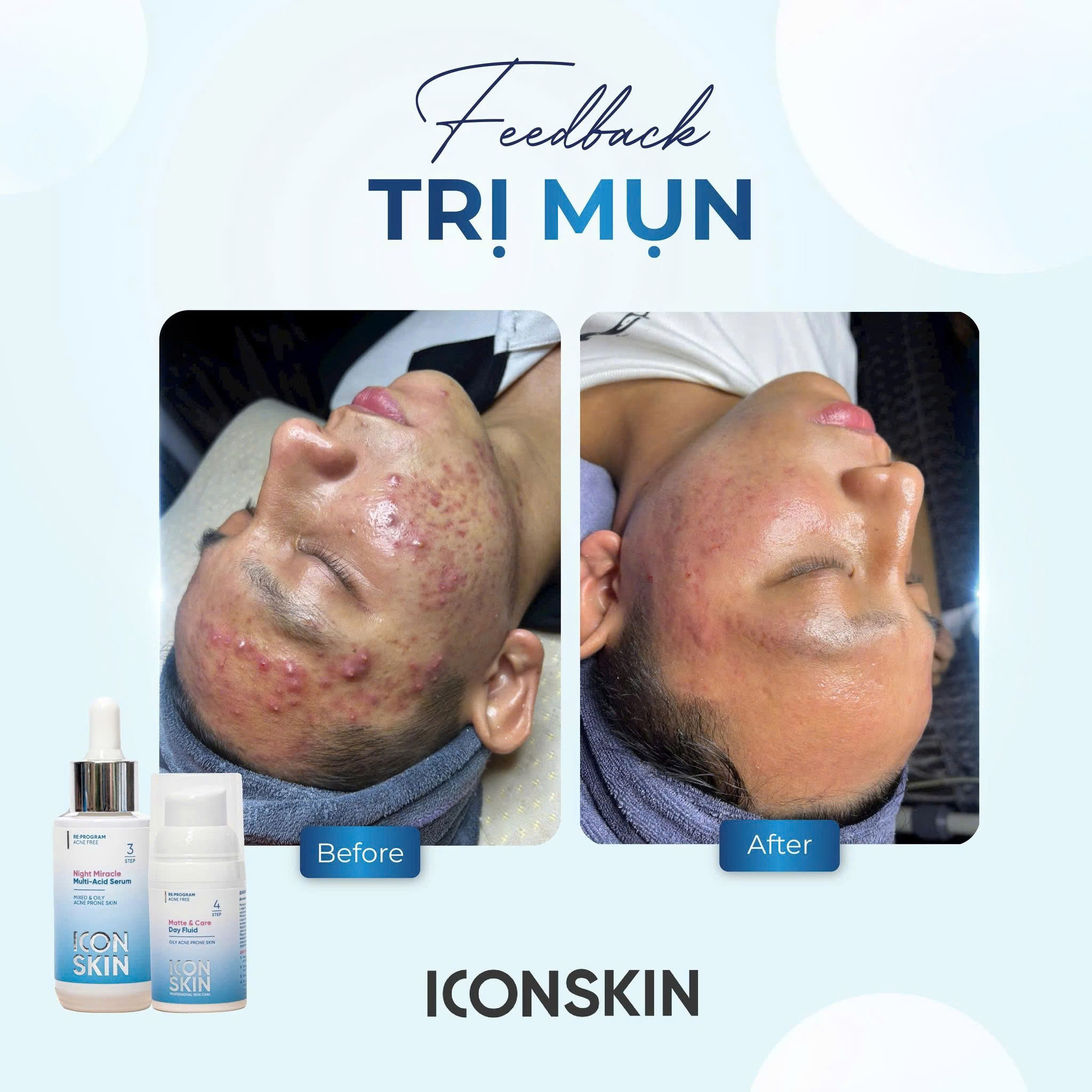 ICON SKIN NIGHT MIRACLE MURRITI - ACID SERUM và MATTE & CARE DAY FLUID : Cặp Đôi Đặc Trị Mụn Ngày Đêm - Thanh Lọc & Kiểm Soát Dầu Nhờn Toàn Diện