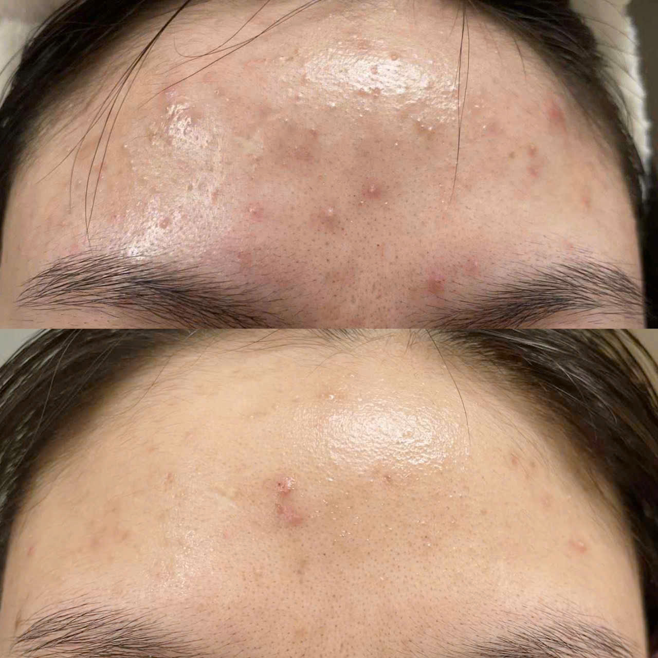 HISTOLAB LIỆU TRÌNH CHĂM SÓC DA MỤN CHUYÊN SÂU: Giải Pháp Thanh Lọc và Tái Tạo Làn Da Khỏe Mạnh