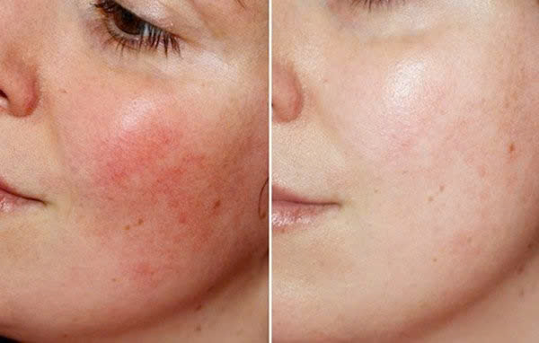 ORMEDIC™ LIFT CÂN BẰNG DA: An Toàn Tuyệt Đối Cho Da Mẹ Bầu & Nhạy Cảm