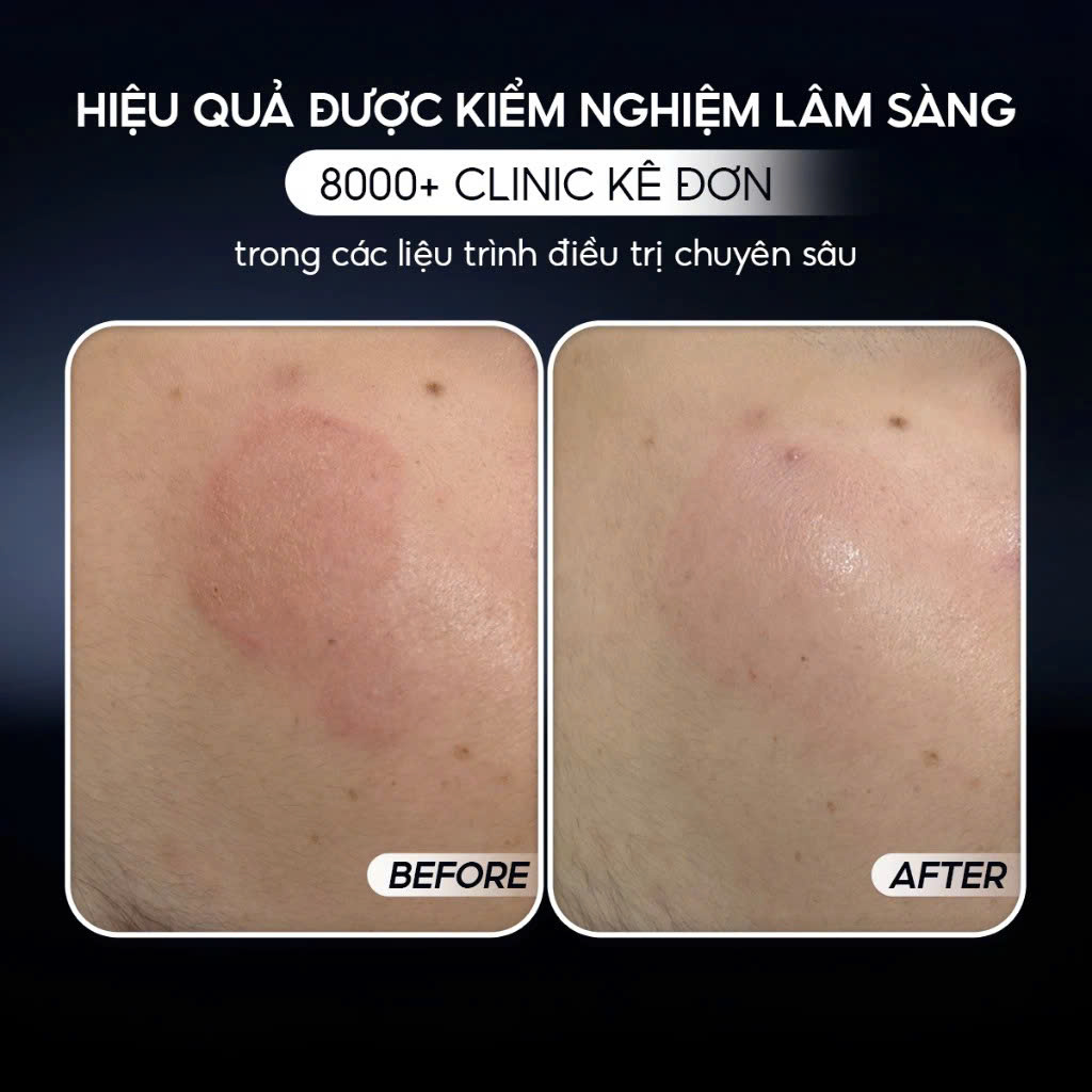 CONAPIDIL CEMENZAL LIGHT (tube) : Kem Dưỡng Hỗ Trợ Tái Tạo & Làm Đầy Sẹo Rỗ - Phục Hồi Chuyên Sâu Từ Tế Bào Gốc