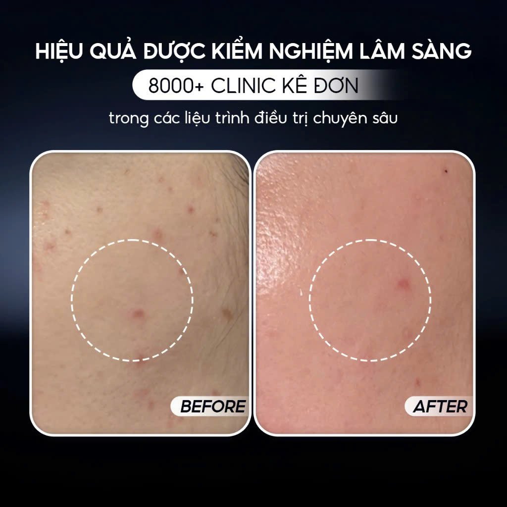 CONAPIDIL SUPERJECTION FIXCICA GEL: Gel Chuyên Biệt Giảm Mụn, Ngừa Thâm Sẹo & Phục Hồi Da Sau Trị Liệu