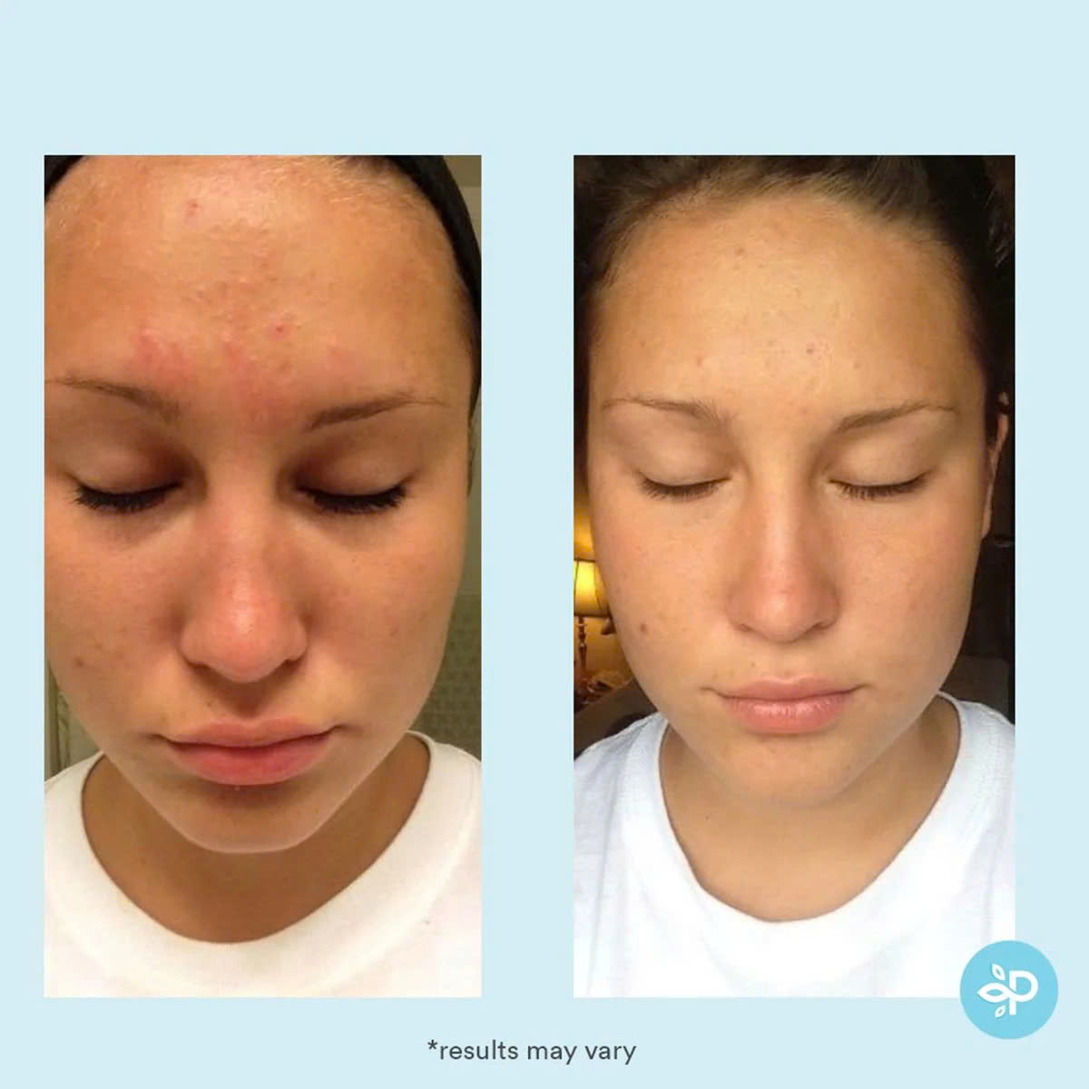 Perfect Image Glycolic 30% Gel Peel: Thay Da Sinh Học Trẻ Hóa, Làm Mịn Và Căng Bóng Da