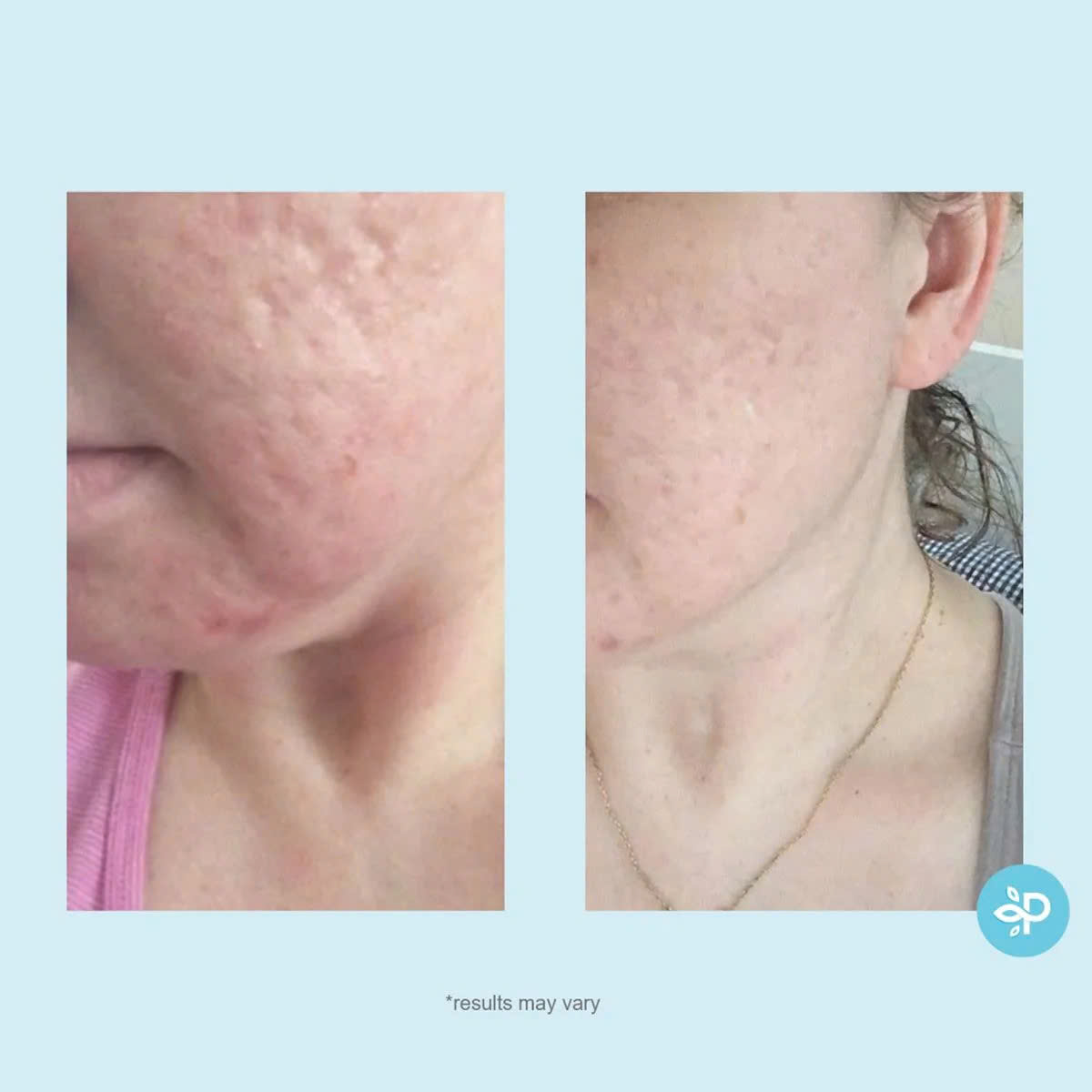 Perfect Image Glycolic 50% Gel Peel: Giải Pháp Thay Da Sinh Học Trẻ Hóa & Tái Tạo Bề Mặt Chuyên Sâu