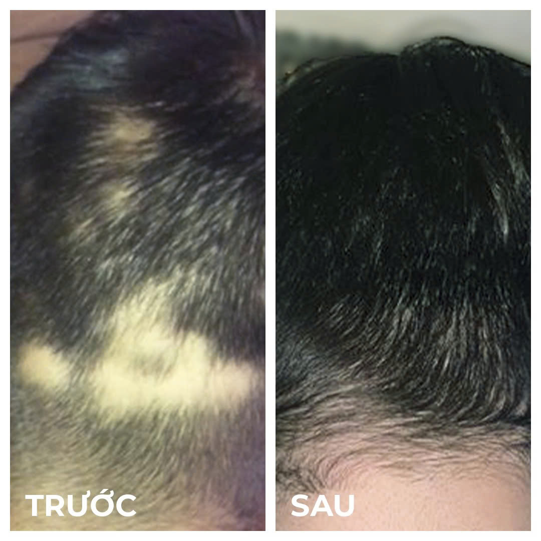 NOURKRIN HAIR GROWTH + IN CLINIC / VIÊN UỐNG MỌC TÓC