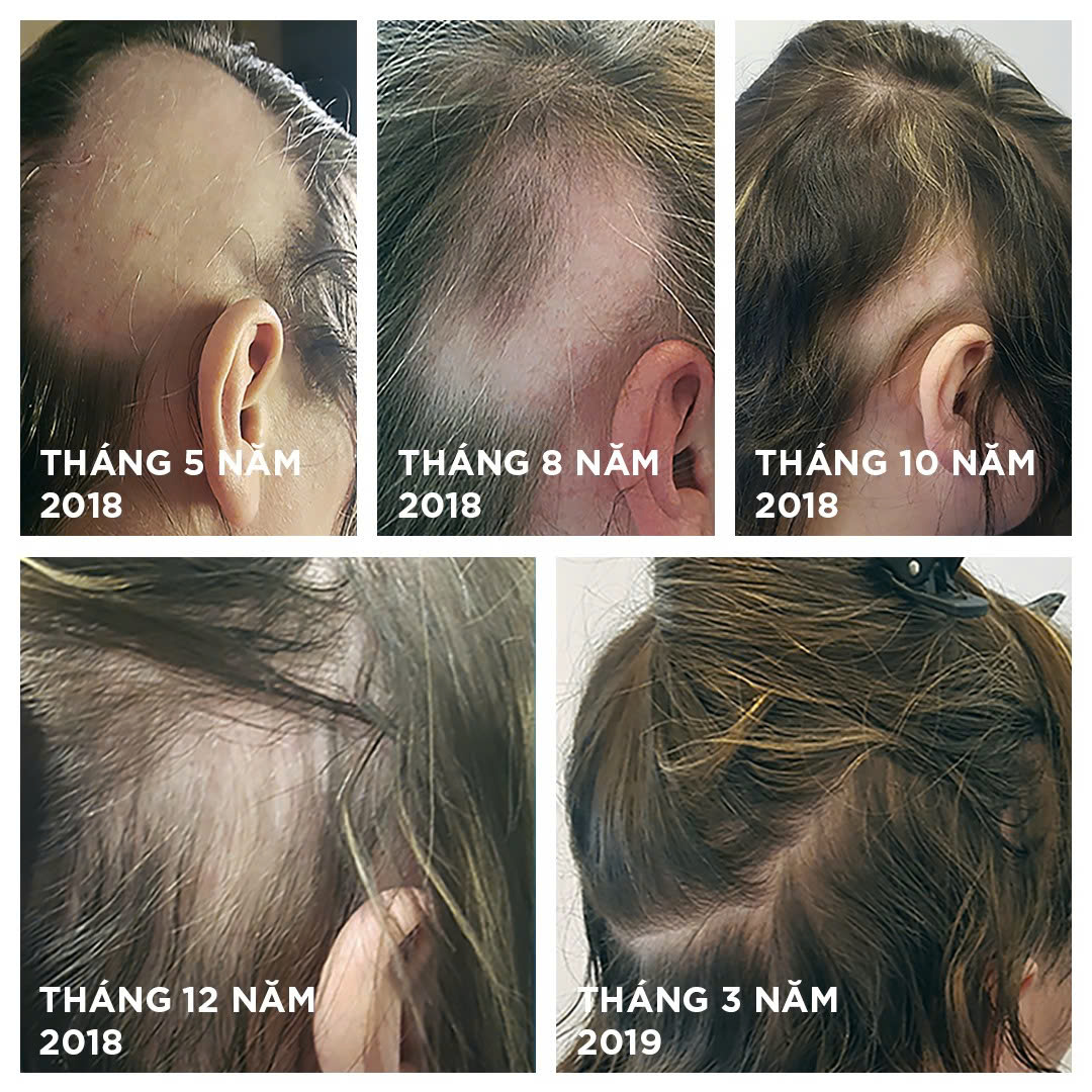 NOURKRIN HAIR GROWTH + IN CLINIC / VIÊN UỐNG MỌC TÓC