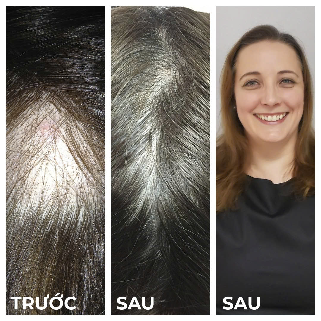 NOURKRIN HAIR GROWTH + IN CLINIC / VIÊN UỐNG MỌC TÓC