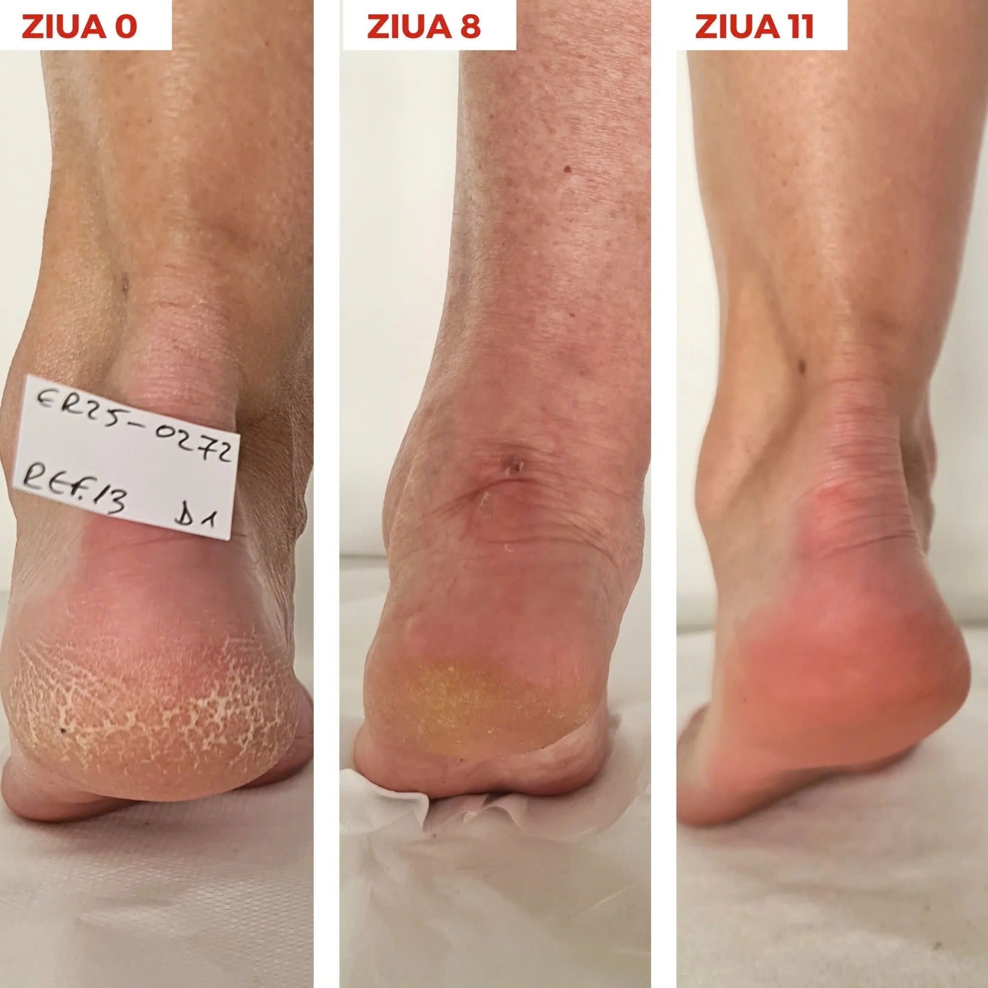 Synergy Therm Xerocare Anti-Callus Cream 40% Urea: Giải Pháp Đặc Trị Da Chai Sần Và Nứt Nẻ