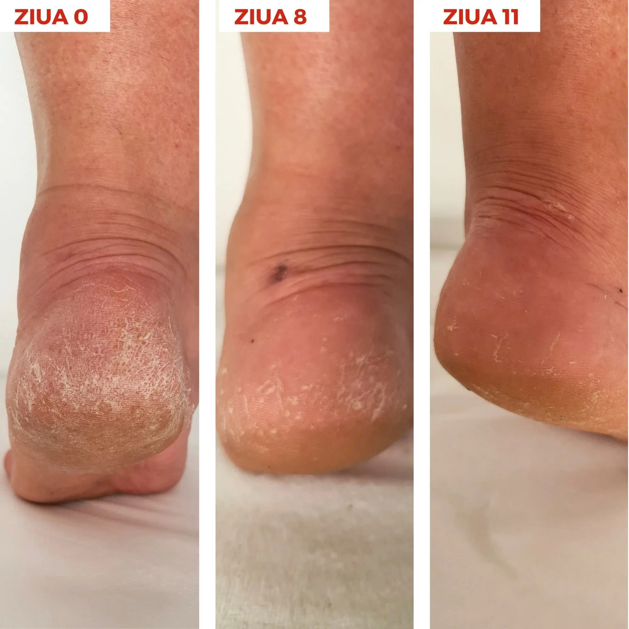 Synergy Therm Xerocare Anti-Callus Cream 40% Urea: Giải Pháp Đặc Trị Da Chai Sần Và Nứt Nẻ