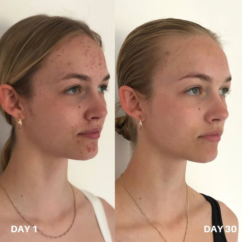 Clinisoothe+ Skin Purifier: Cuộc Cách Mạng Kháng Khuẩn Và Phục Hồi Da Đa Năng