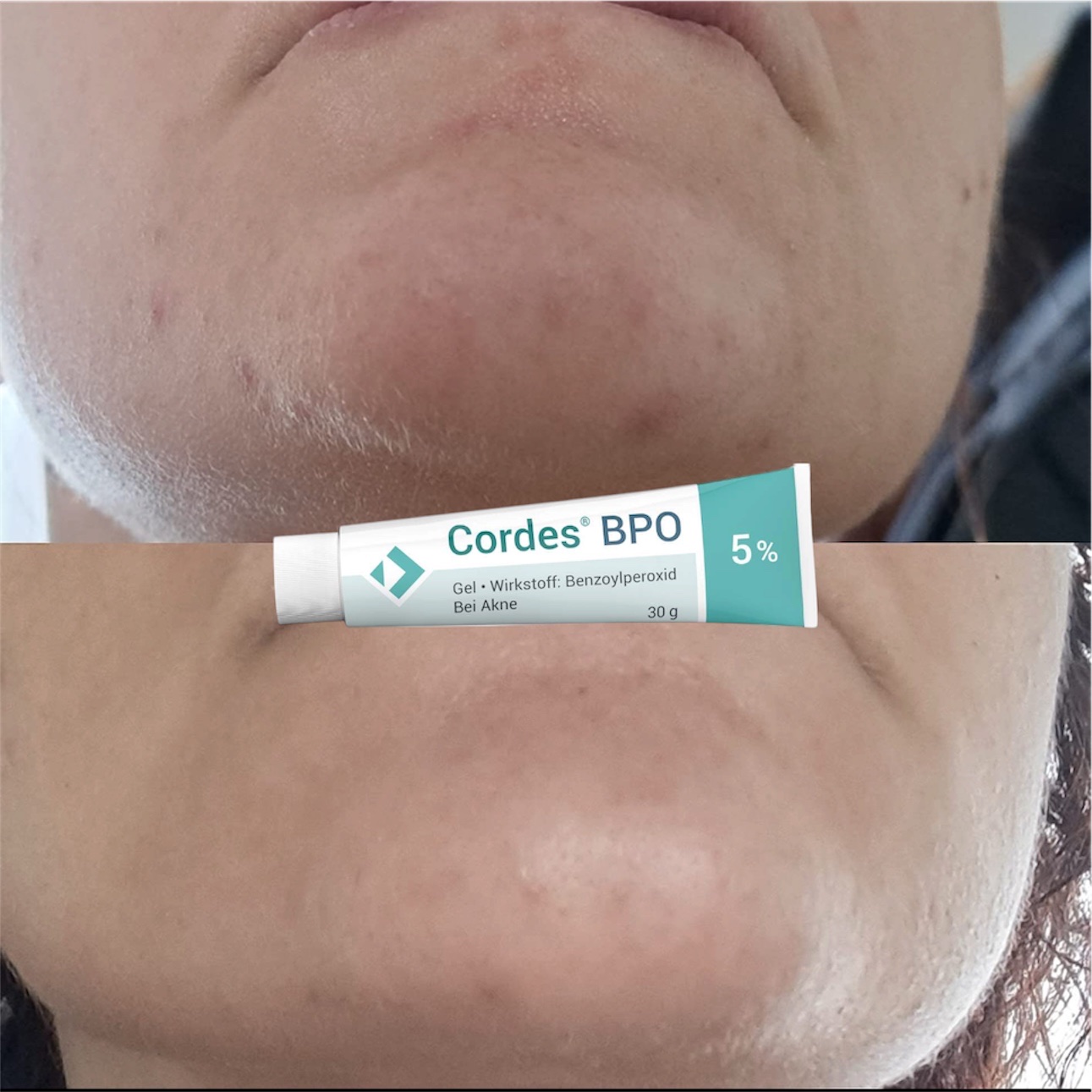 Cordes® BPO 5% Gel – Giải Pháp Đặc Trị Mụn Trứng Cá Cấp Độ Trung Bình
