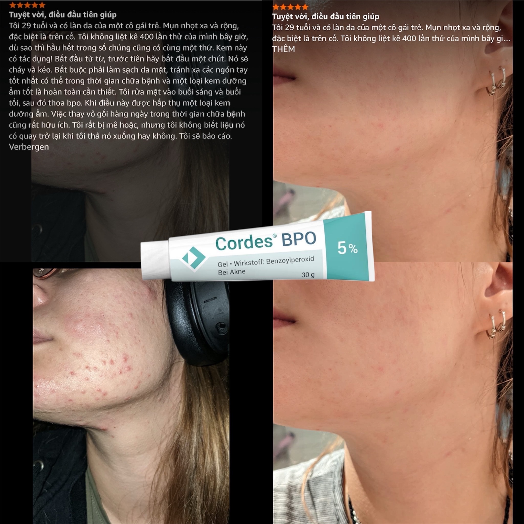 Cordes® BPO 5% Gel – Giải Pháp Đặc Trị Mụn Trứng Cá Cấp Độ Trung Bình