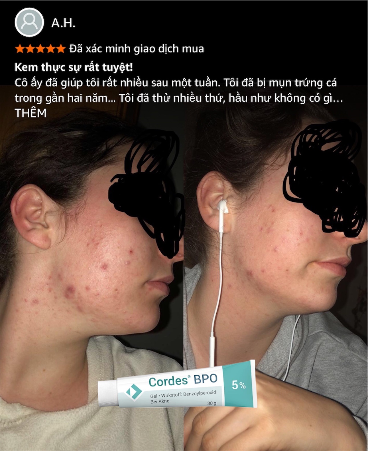 Cordes® BPO 5% Gel – Giải Pháp Đặc Trị Mụn Trứng Cá Cấp Độ Trung Bình
