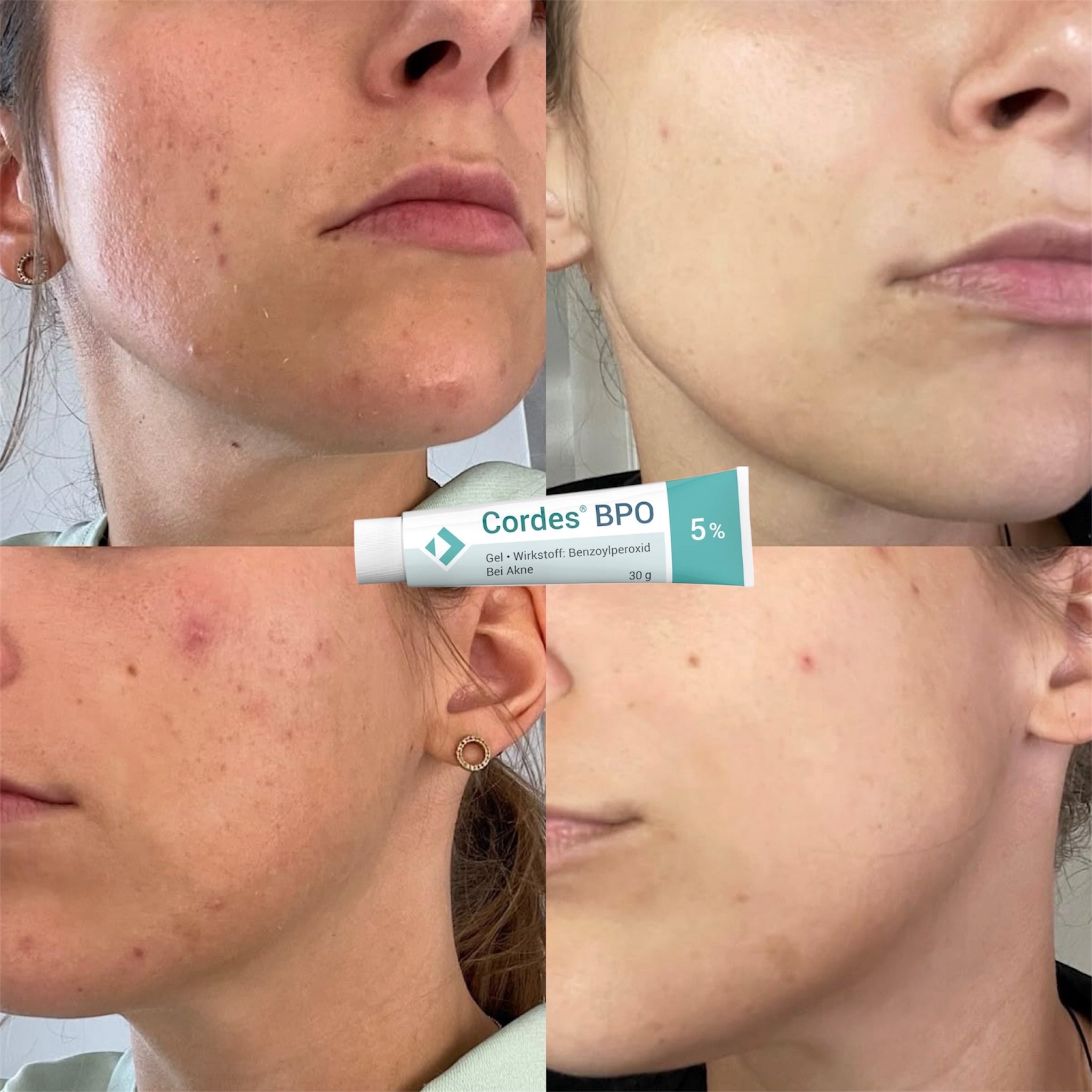 Cordes® BPO 5% Gel – Giải Pháp Đặc Trị Mụn Trứng Cá Cấp Độ Trung Bình
