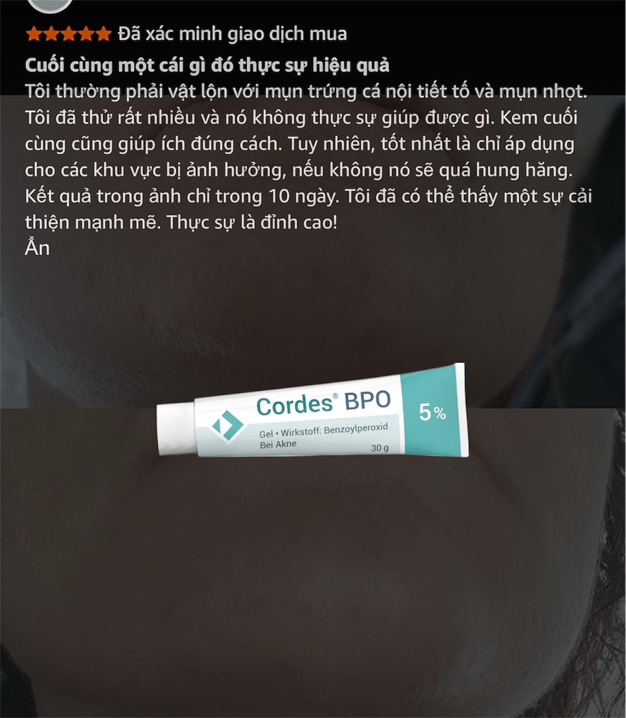 Cordes® BPO 5% Gel – Giải Pháp Đặc Trị Mụn Trứng Cá Cấp Độ Trung Bình