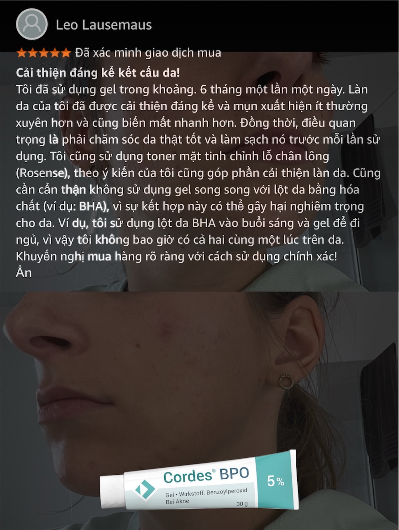 Cordes® BPO 5% Gel – Giải Pháp Đặc Trị Mụn Trứng Cá Cấp Độ Trung Bình