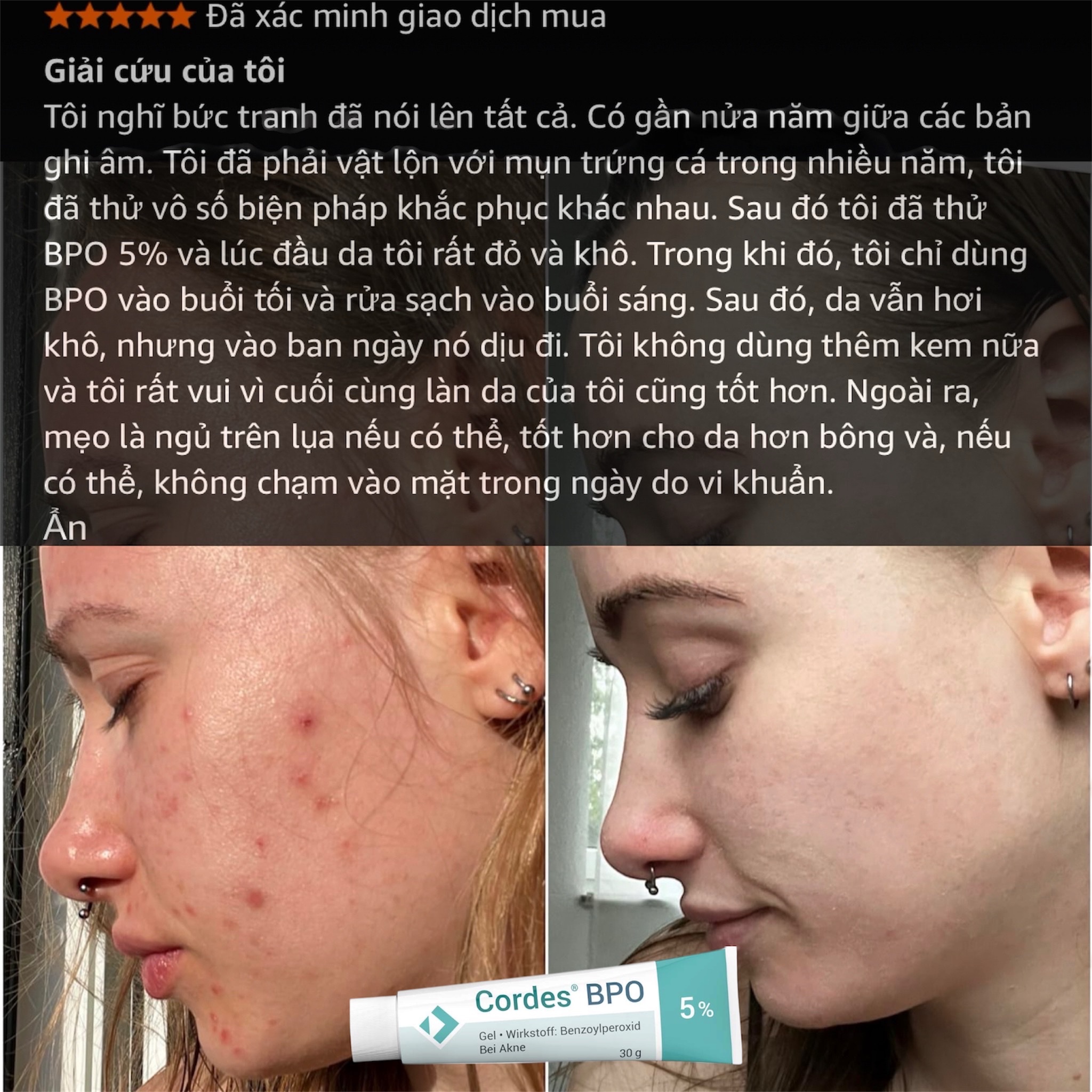 Cordes® BPO 5% Gel – Giải Pháp Đặc Trị Mụn Trứng Cá Cấp Độ Trung Bình