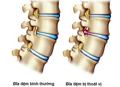 Thoát vị đĩa đệm: Nguyên nhân, triệu chứng, chẩn đoán và điều trị