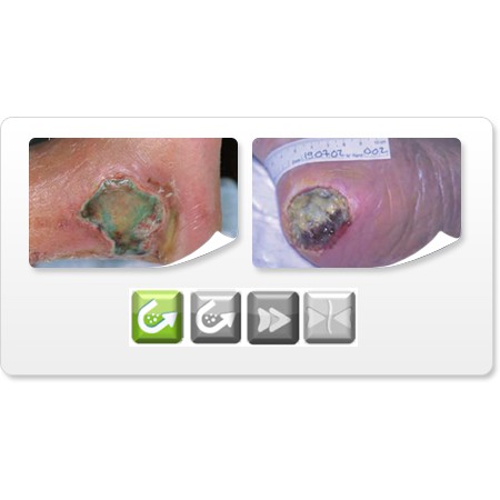 Gạc Lưới Chống Dính Urgo URGOTUL AG/SILVER (Muối Bạc)