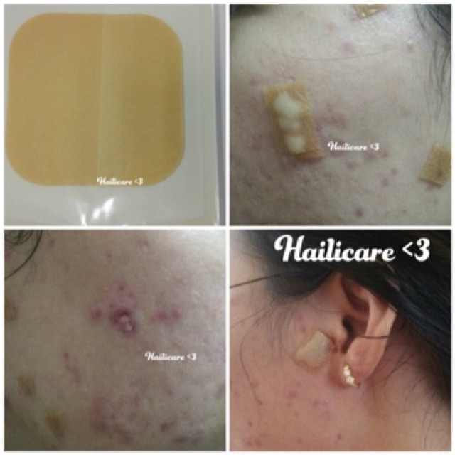 Băng Dán Vết Thương DuoDerm Extra Thin