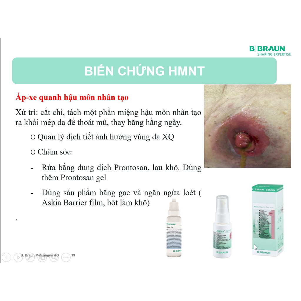 Túi Hậu Môn Nhân Tạo 1 Mảnh B.Braun Proxima (Sử Dụng Kẹp)