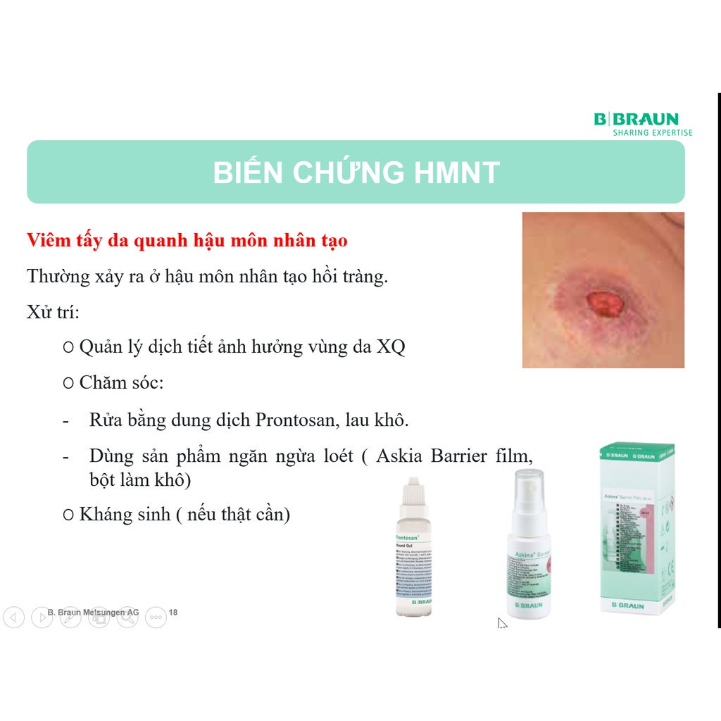 Túi Hậu Môn Nhân Tạo 1 Mảnh B.Braun Proxima (Sử Dụng Kẹp)