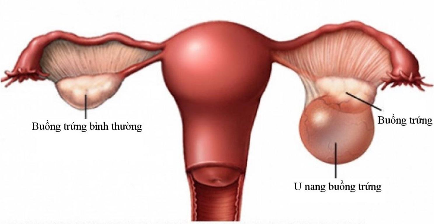 NGUYÊN NHÂN VÀ TRIỆU CHỨNG BỆNH U NANG BUỒNG TRỨNG