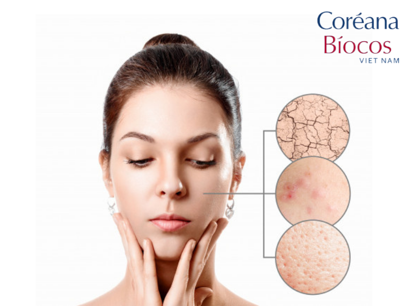 Những dấu hiệu cảnh báo da bạn đang mất nước và cách khắc phục hiệu quả
