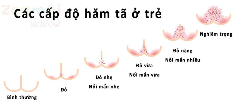 Hăm tã ở trẻ nhỏ là gì? Nguyên nhân, triệu chứng và cách phòng ngừa Hăm tã ở trẻ nhỏ là gì? Nguyên nhân, triệu chứng và cách phòng ngừa