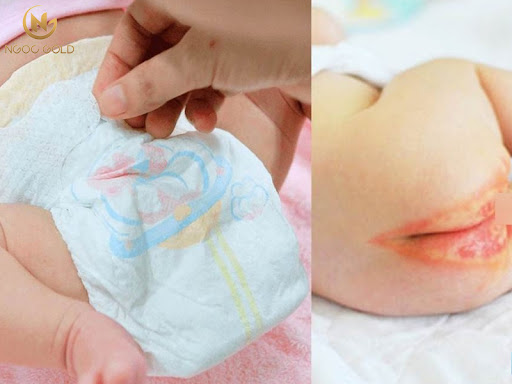 Các nguyên nhân gây hăm tã ở trẻ sơ sinh và biện pháp cải thiện Các nguyên nhân gây hăm tã ở trẻ sơ sinh và biện pháp cải thiện
