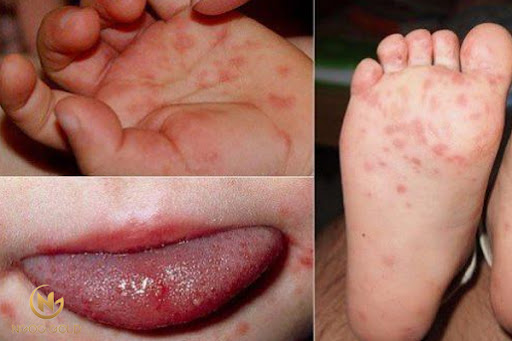 TOP bệnh giao mùa ở trẻ đặc biệt nguy hiểm mà cha mẹ cần quan tâm TOP bệnh giao mùa ở trẻ đặc biệt nguy hiểm mà cha mẹ cần quan tâm