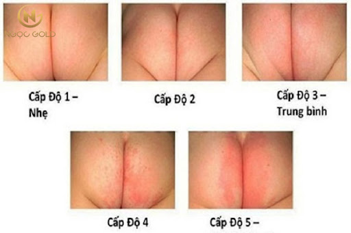5 cấp độ hăm tã trên da bé từ nhẹ tới nặng 5 cấp độ hăm tã trên da bé từ nhẹ tới nặng