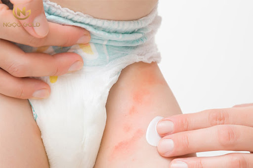 5 cách chữa hăm tã trẻ em đơn giản tại nhà 5 cách chữa hăm tã trẻ em đơn giản tại nhà