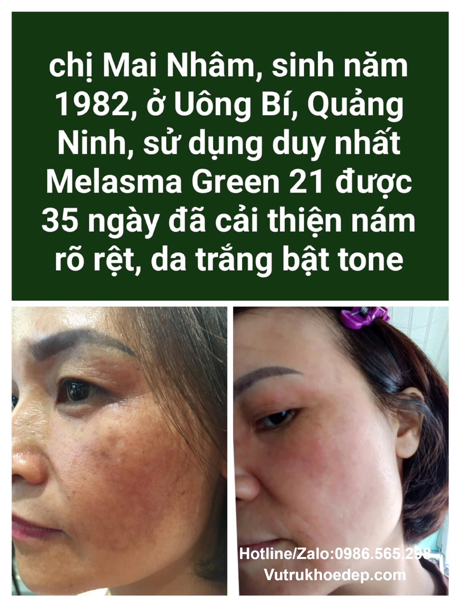 Khám phá sức mạnh vượt trội của Kem Melasma Green 21 - Lựa chọn hoàn hảo cho làn da sáng mịn