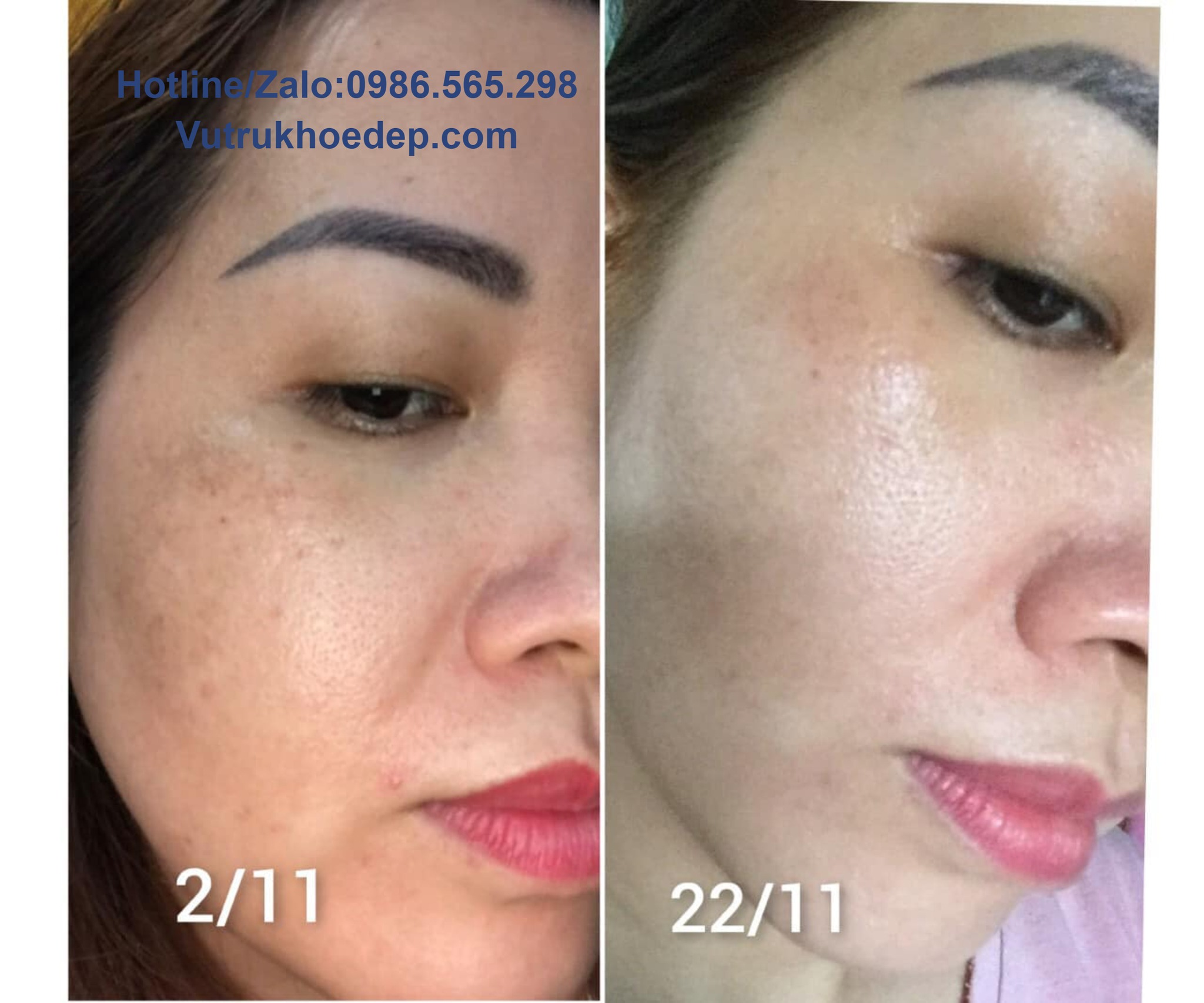 Melasma Green 21 – Giải pháp tối ưu giúp bạn xóa tan nỗi lo nám da và độc tố trong da