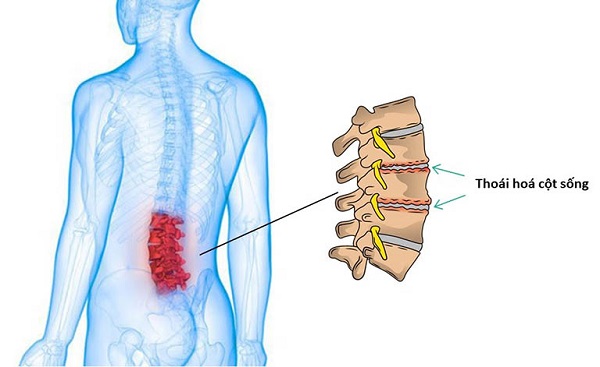 Thoái hóa cột sống lưng là về bệnh gì
