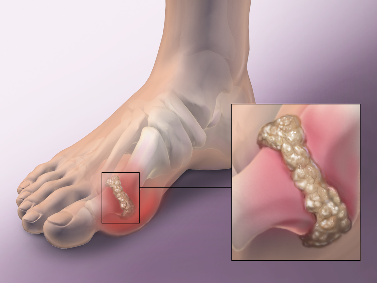 Axit uric là nguyên nhân gây ra bệnh gout