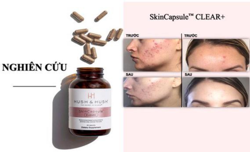 Viên uống trị mụn Hush & Hush Skin Capsule Clear+