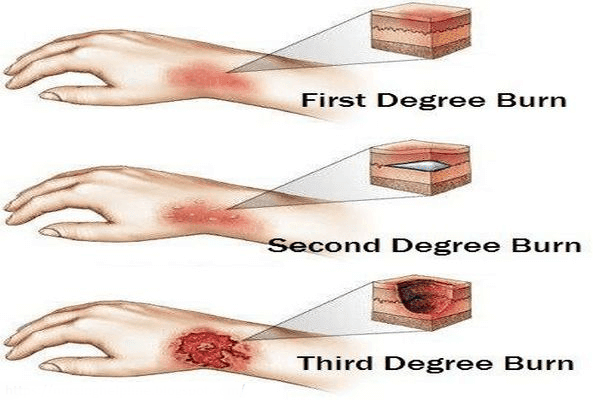 RỬA VẾT THƯƠNG BỎNG BẰNG DR.ECA