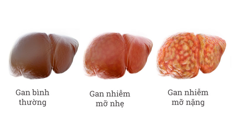 gan nhiễm mỡ