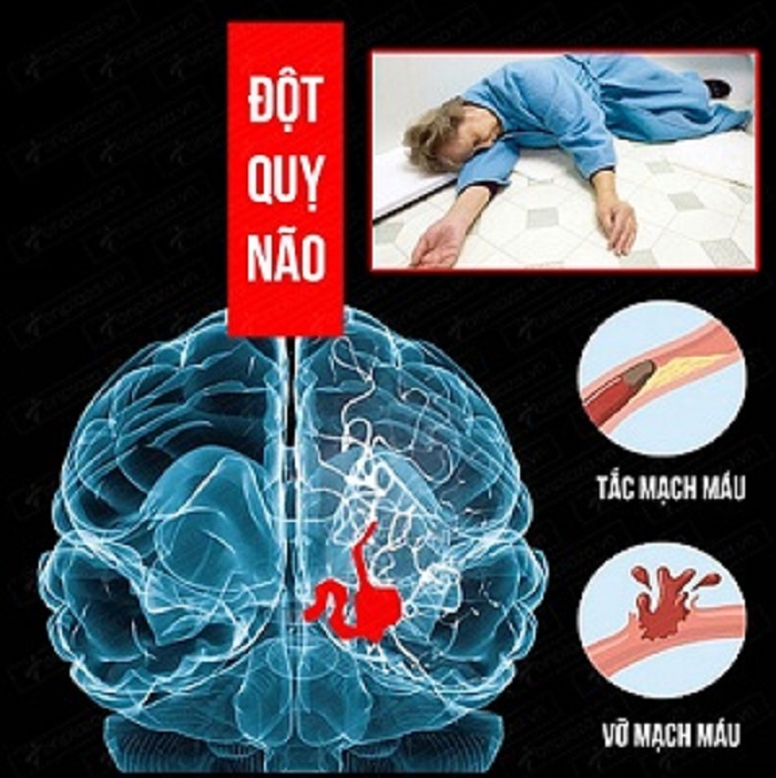 Các Biện Pháp Phòng Chống Đột Quỵ.