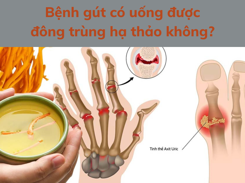 Bệnh gút có dùng được đông trùng hạ thảo giúp giảm đau nhức