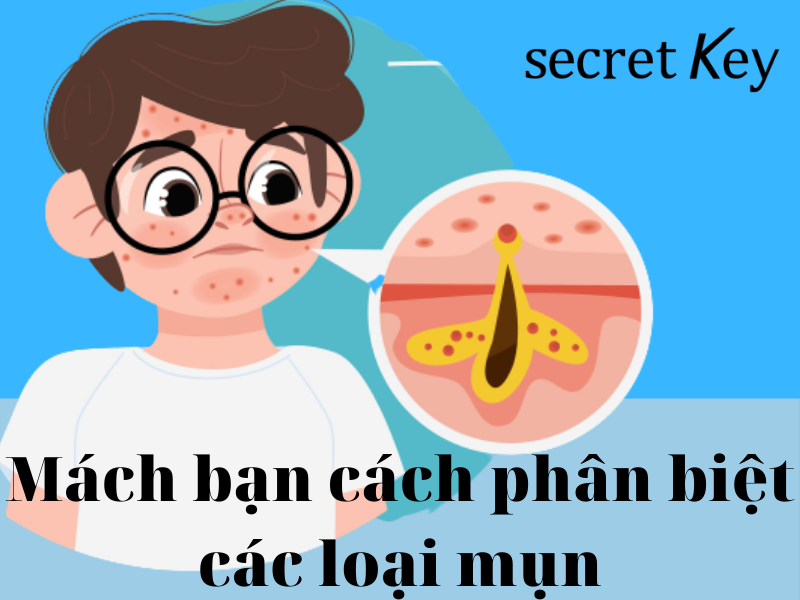 Mách bạn cách phân biệt các loại mụn thường gặp