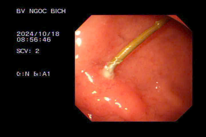 MỘT CA LẤY DỊ VẬT QUA ĐƯỜNG NỘI SOI DẠ DÀY THÀNH CÔNG VỪA DIỄN RA TẠI BỆNH VIỆN ĐA KHOA NGỌC BÍCH