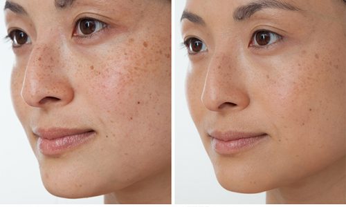 4 lưu ý không thể bỏ qua khi sử dụng kem dưỡng trị thâm nám