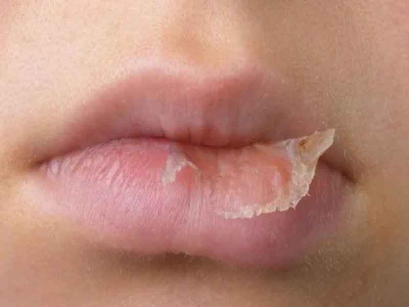 Nguyên nhân khiến đôi môi bị khô có thể là do cơ thể bị thiếu nước