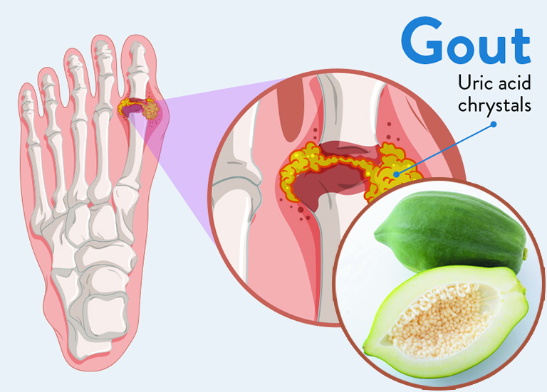 Mẹo chữa bệnh gout bằng đu đủ và lá trà xanh Mẹo chữa bệnh gout bằng đu đủ và lá trà xanh