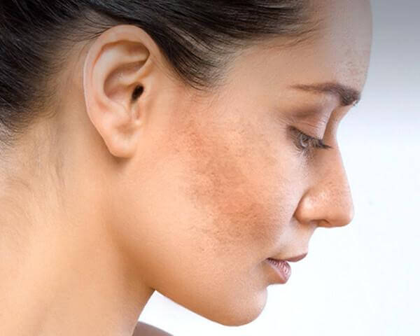 Nám Da: Nguyên Nhân, Cách Phòng Tránh và Điều Trị Hiệu Quả