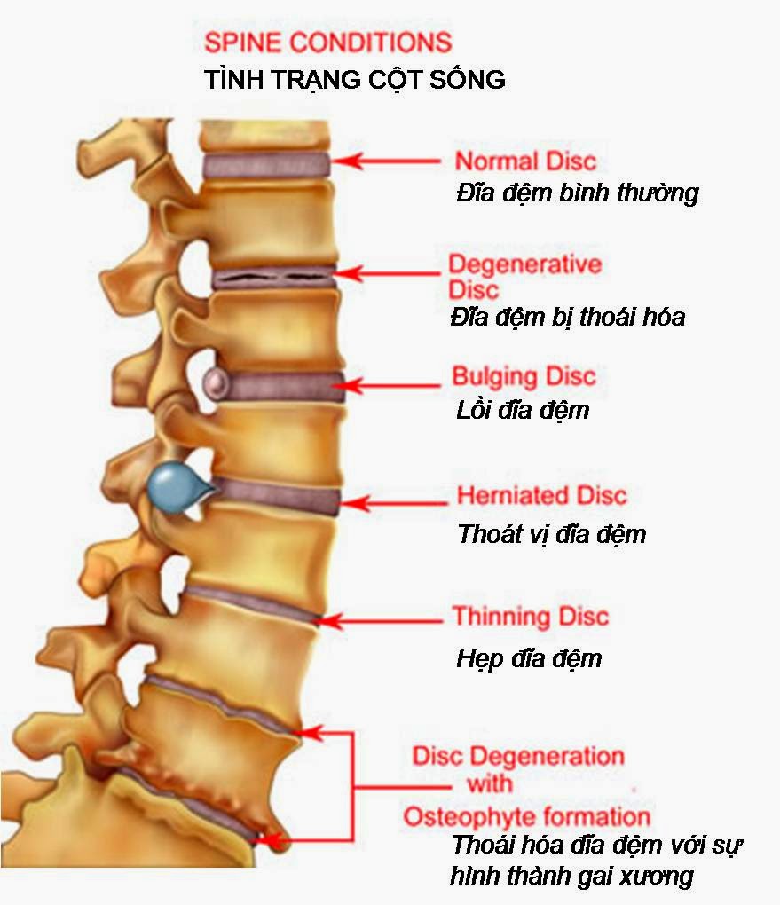 Chữa dứt điểm bệnh thoát vị đĩa đệm nhờ đi xe đạp thể thao