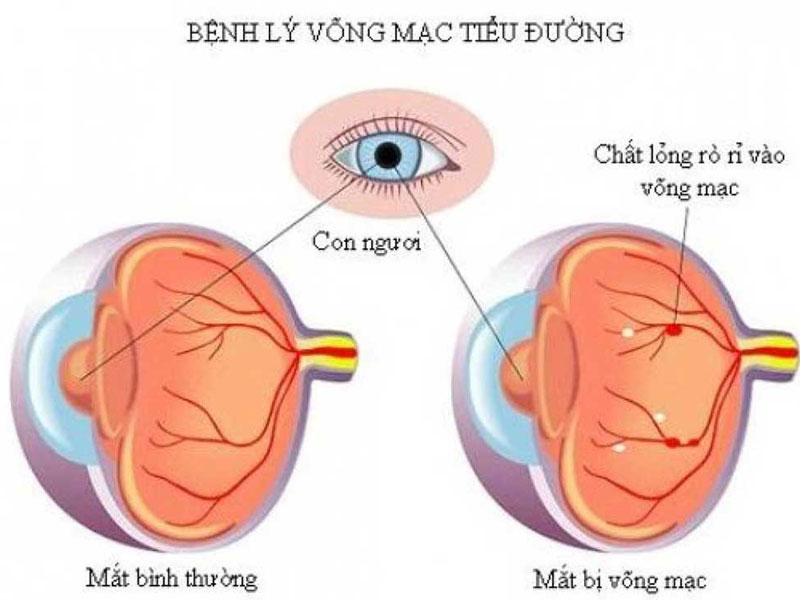 BỆNH VÕNG MẠC ĐÁI THÁO ĐƯỜNG