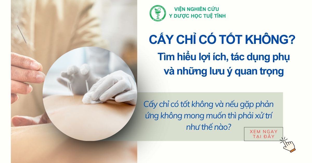Cấy chỉ có tốt không? Tìm hiểu lợi ích, tác dụng phụ và những lưu ý quan trọng